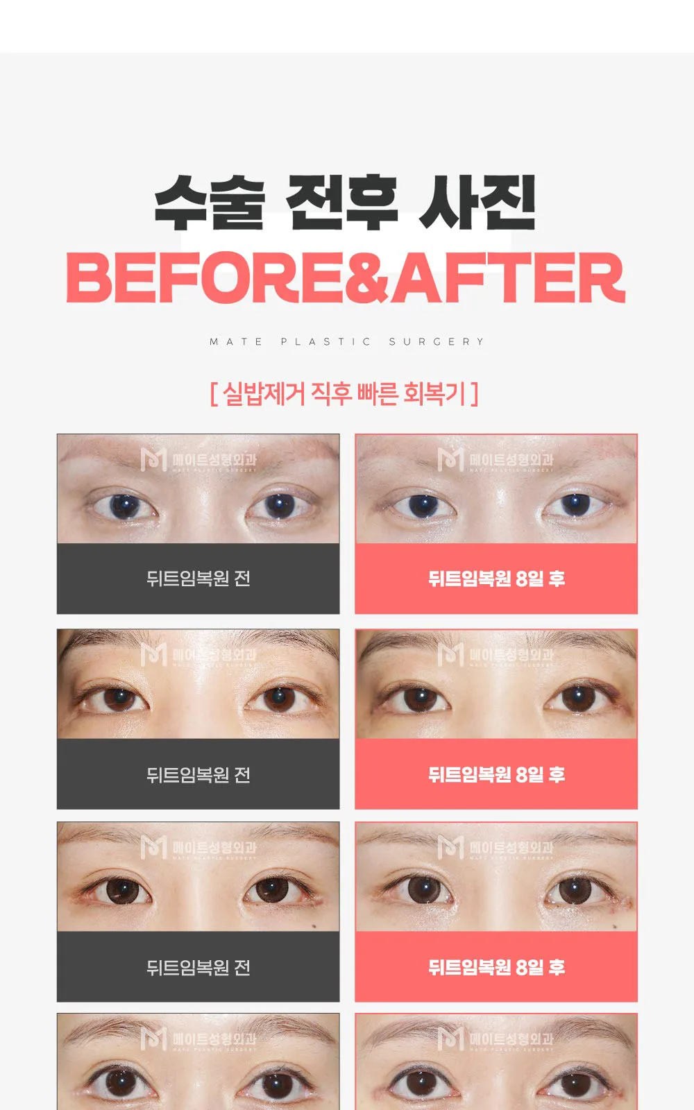 시술 상세 2