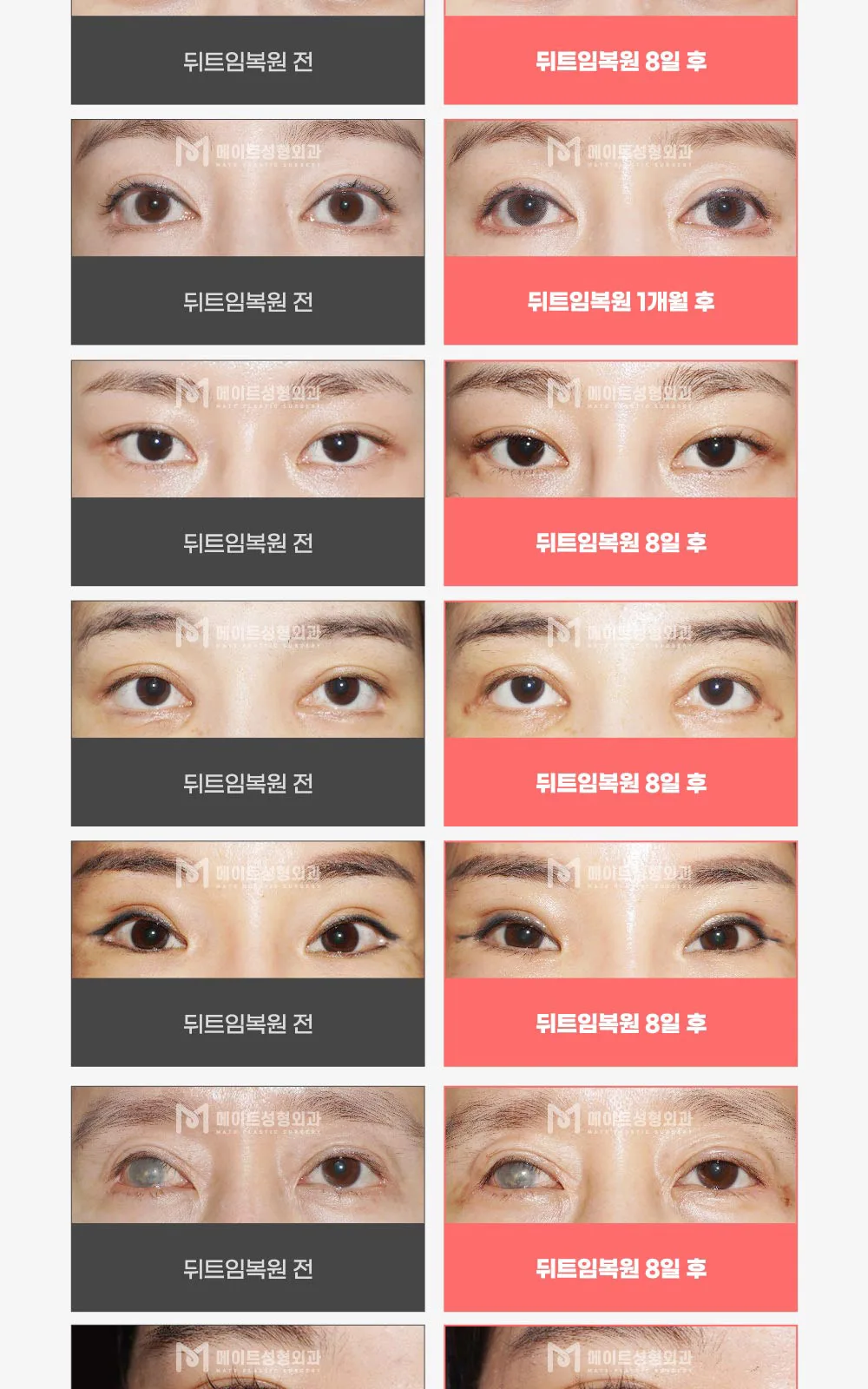 시술 상세 3