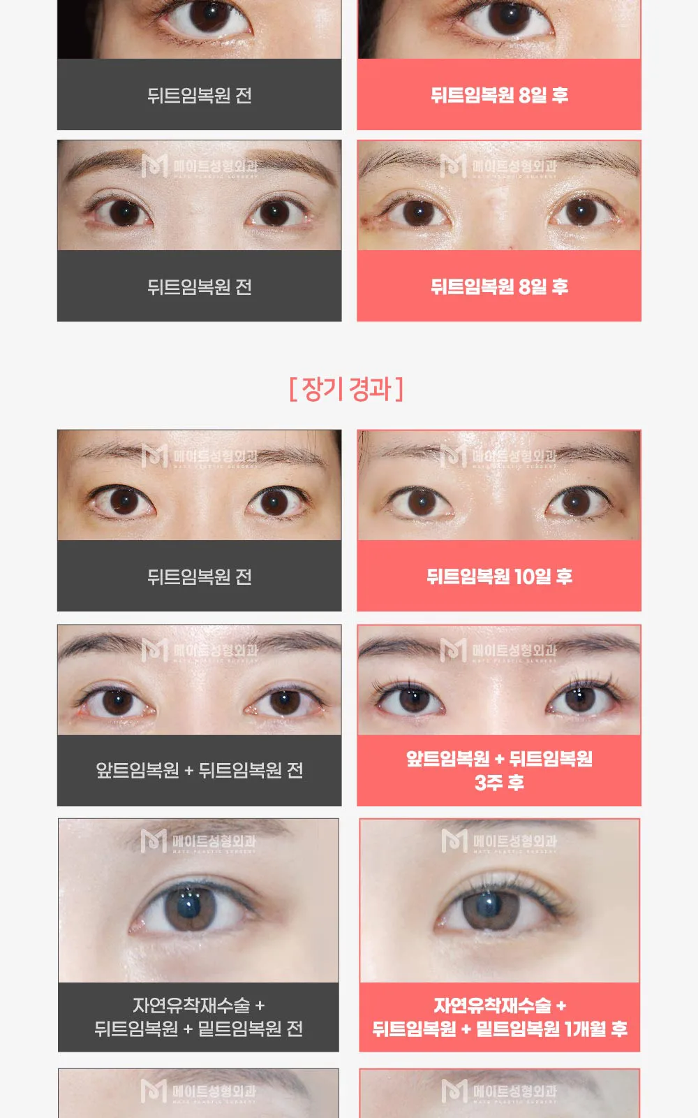 시술 상세 4