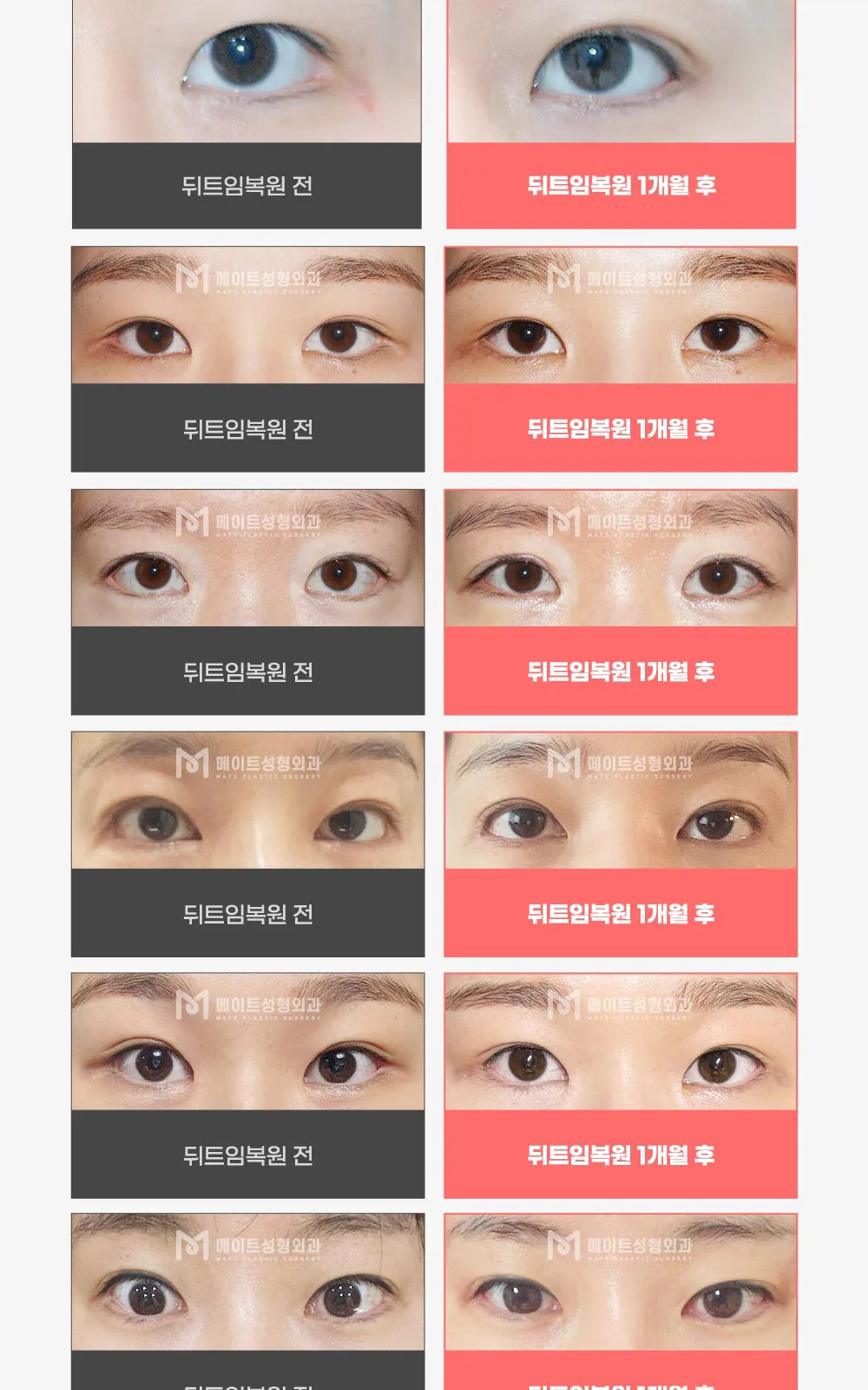 시술 상세 5
