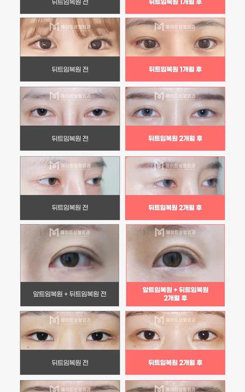 시술 상세 6