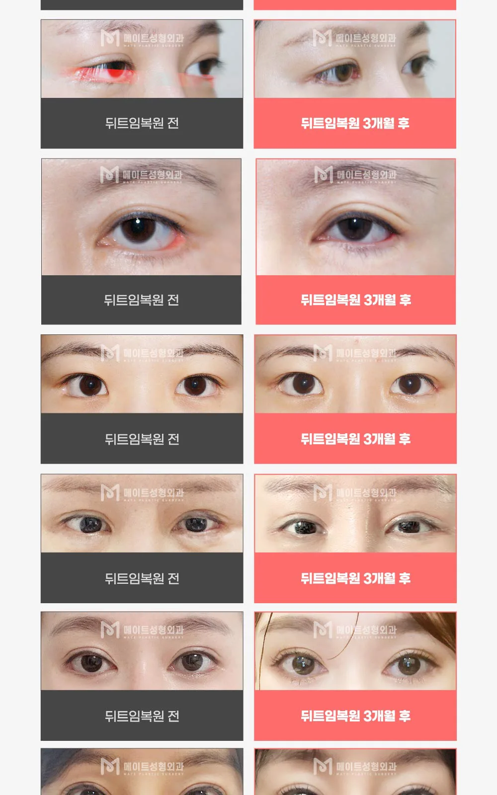 시술 상세 8