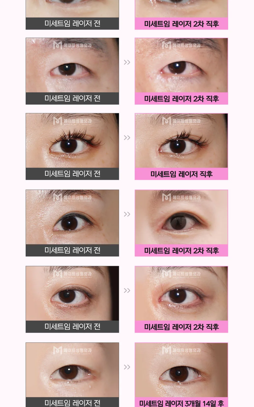 시술 상세 13