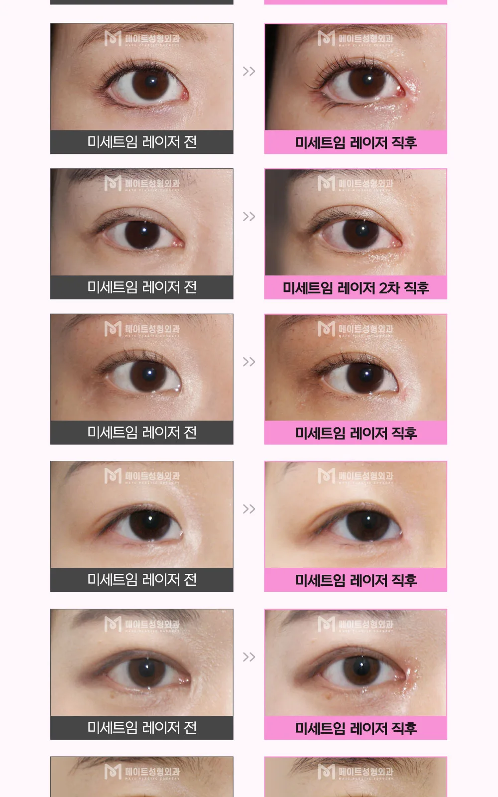 시술 상세 14