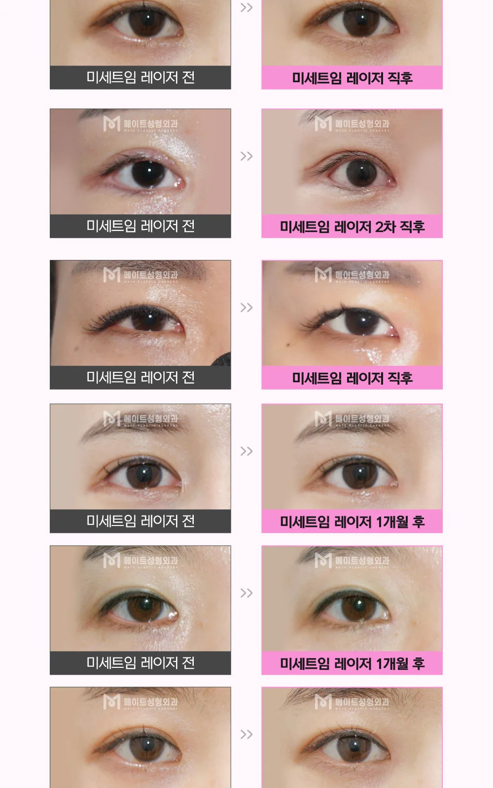시술 상세 15