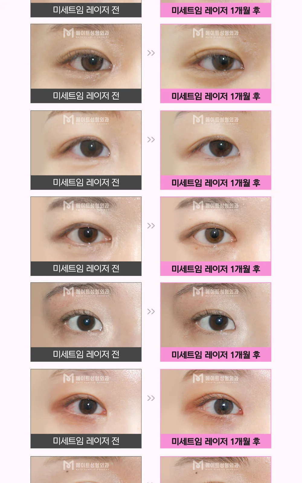 시술 상세 16