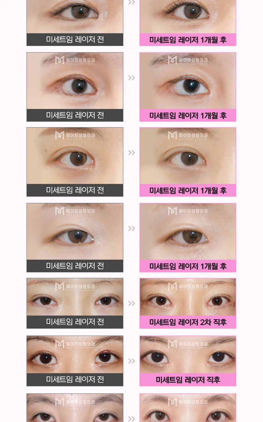 시술 상세 17