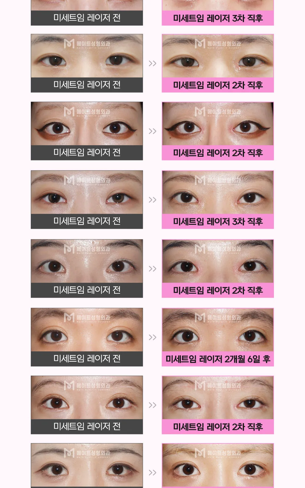 시술 상세 18