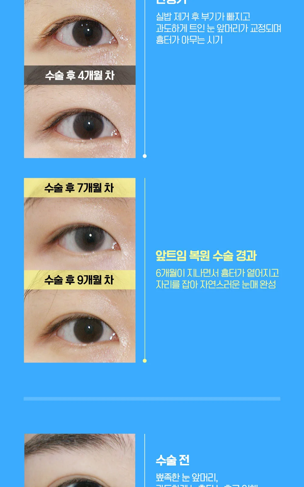 시술 상세 5
