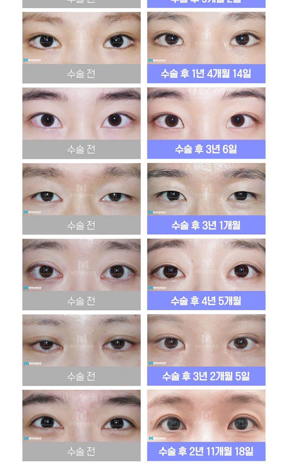 시술 상세 20