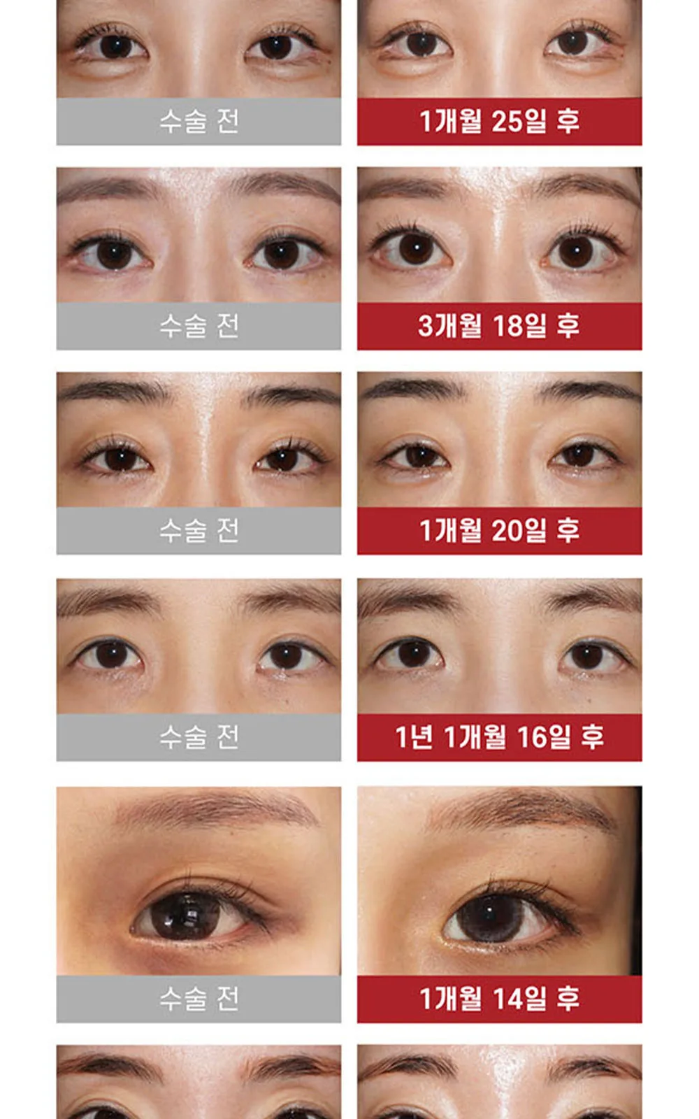 시술 상세 11