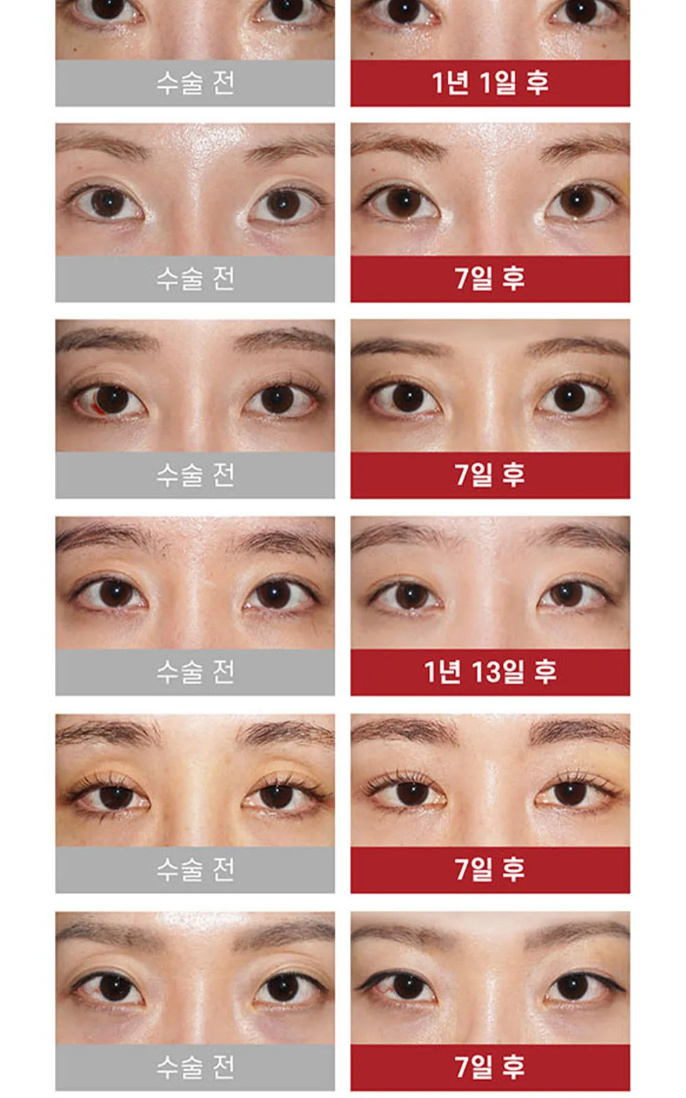시술 상세 12