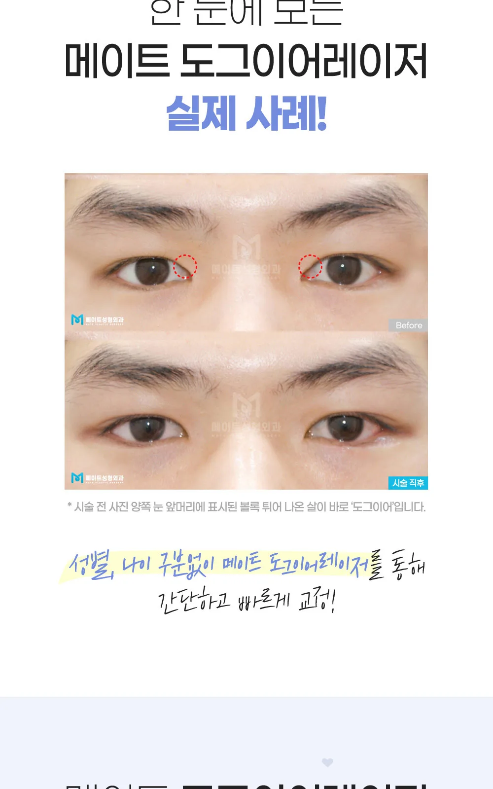 시술 상세 5