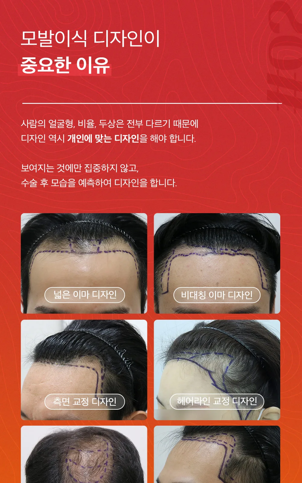 시술 상세 4