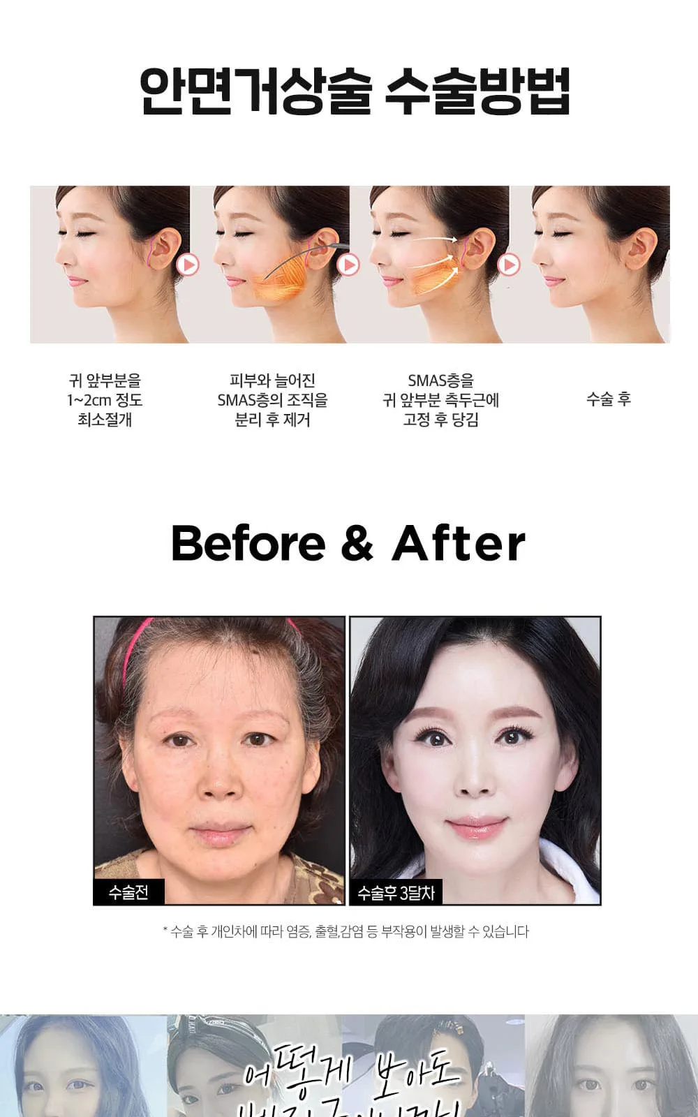 시술 상세 11