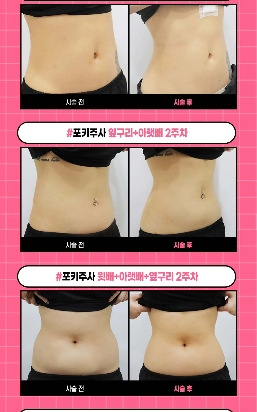 시술 상세 5