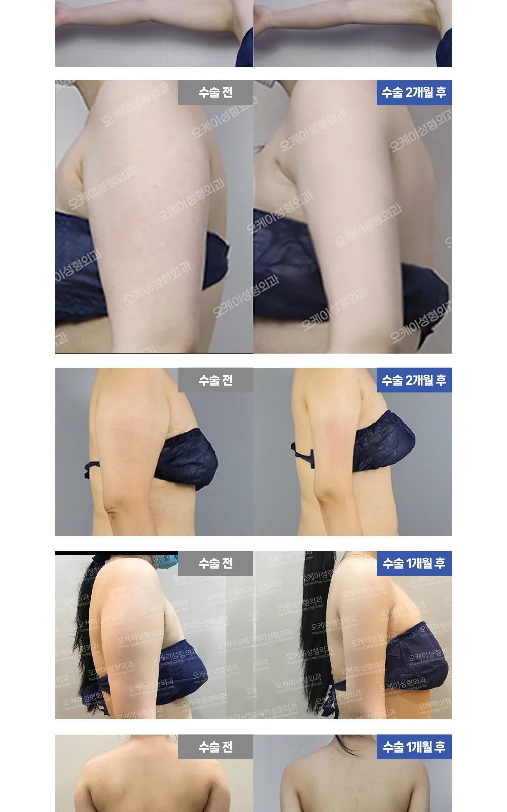 시술 상세 3