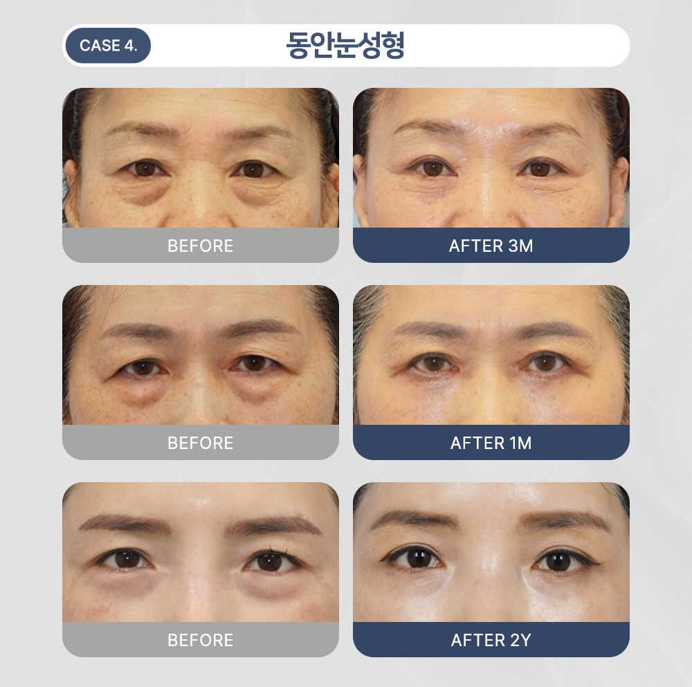 시술 상세 5