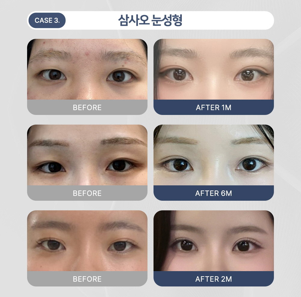 시술 상세 5