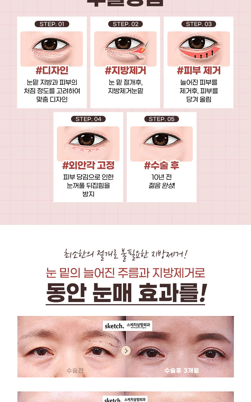 시술 상세 2