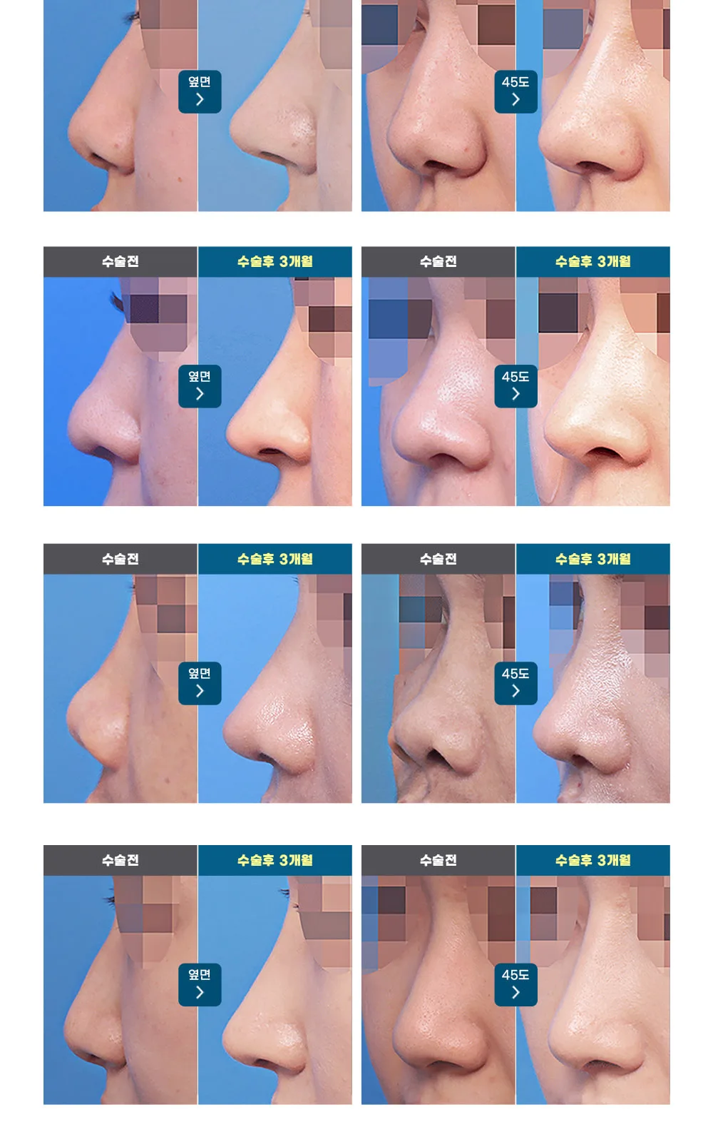 시술 상세 3