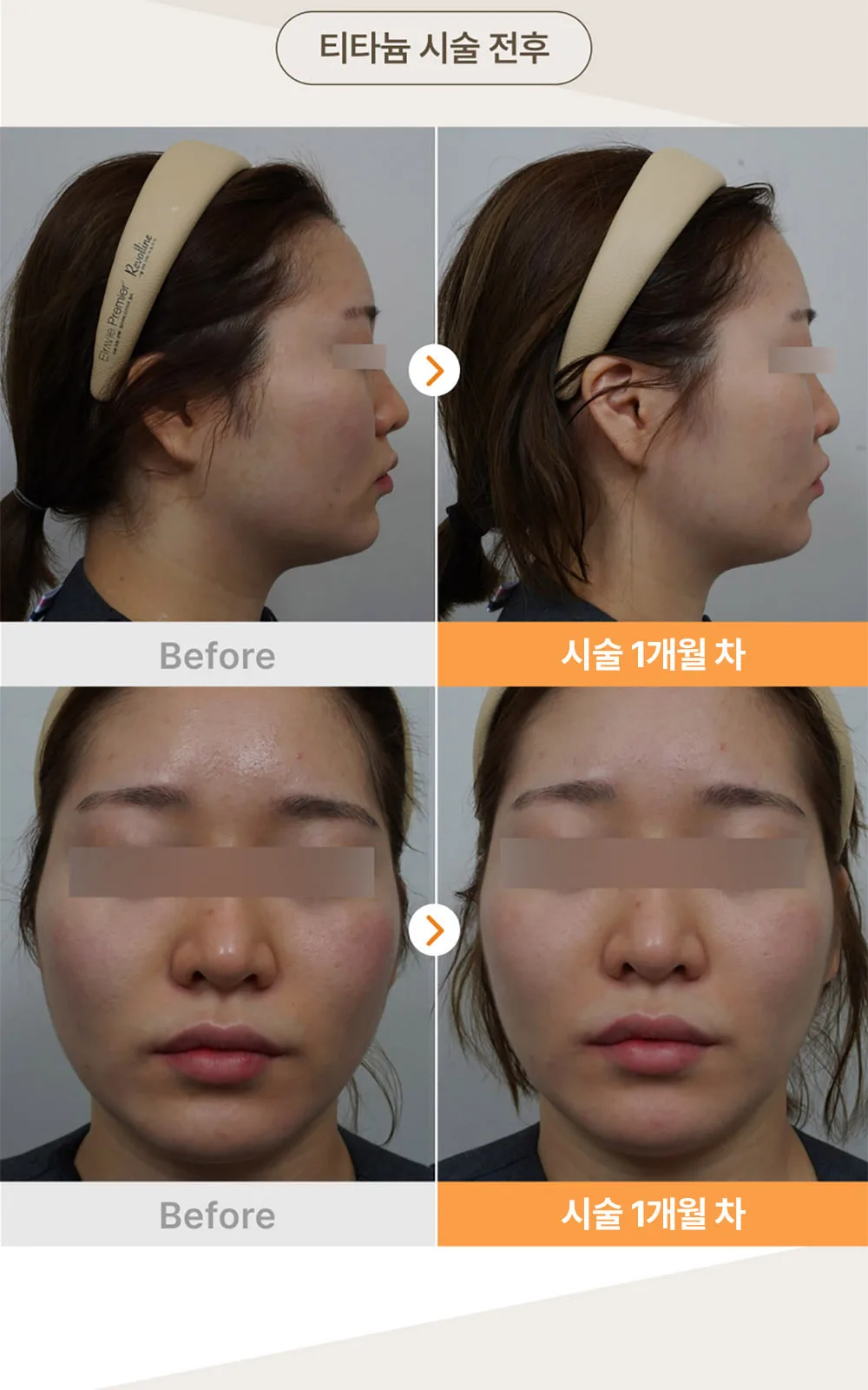 시술 상세 6