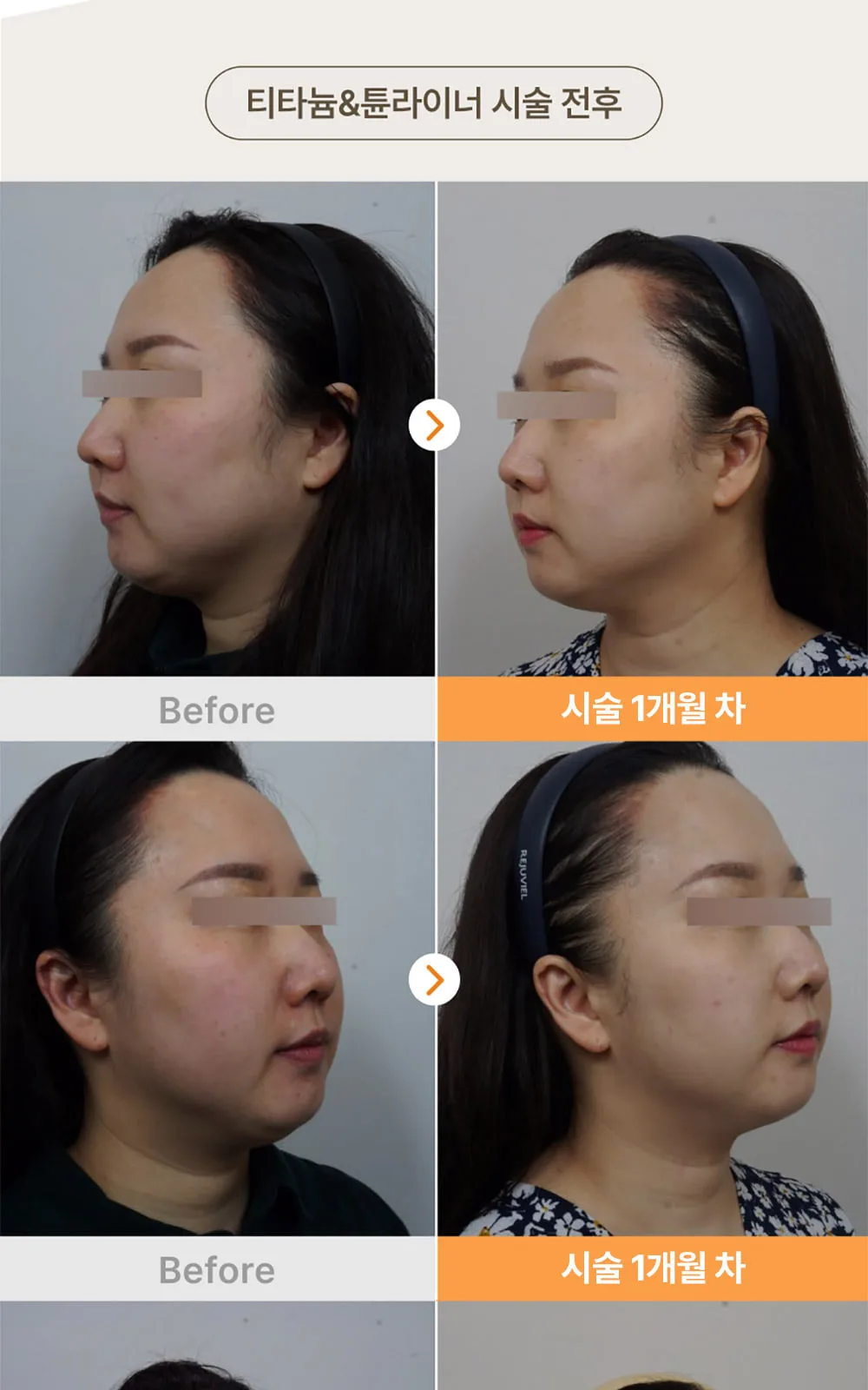 시술 상세 7