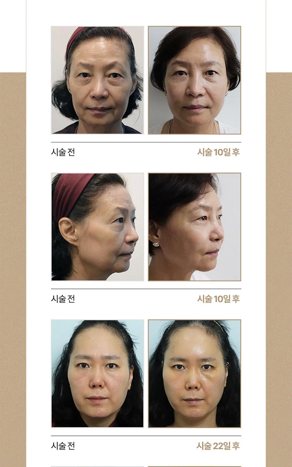 시술 상세 11
