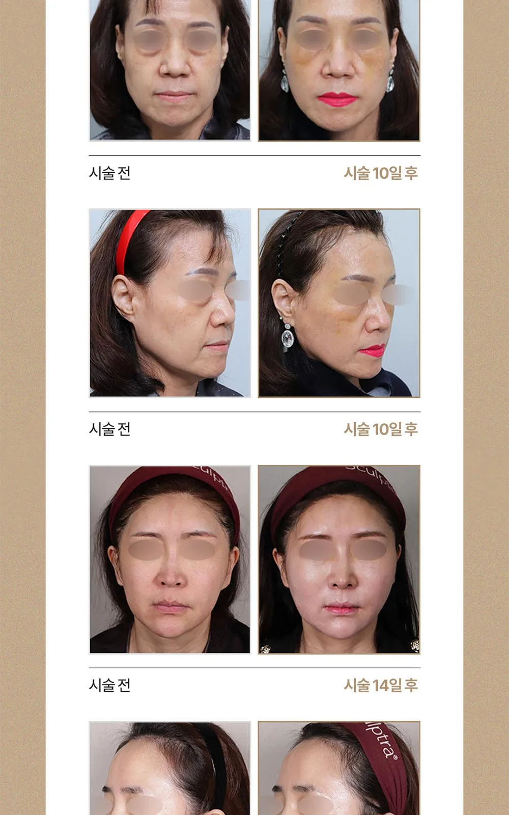 시술 상세 13