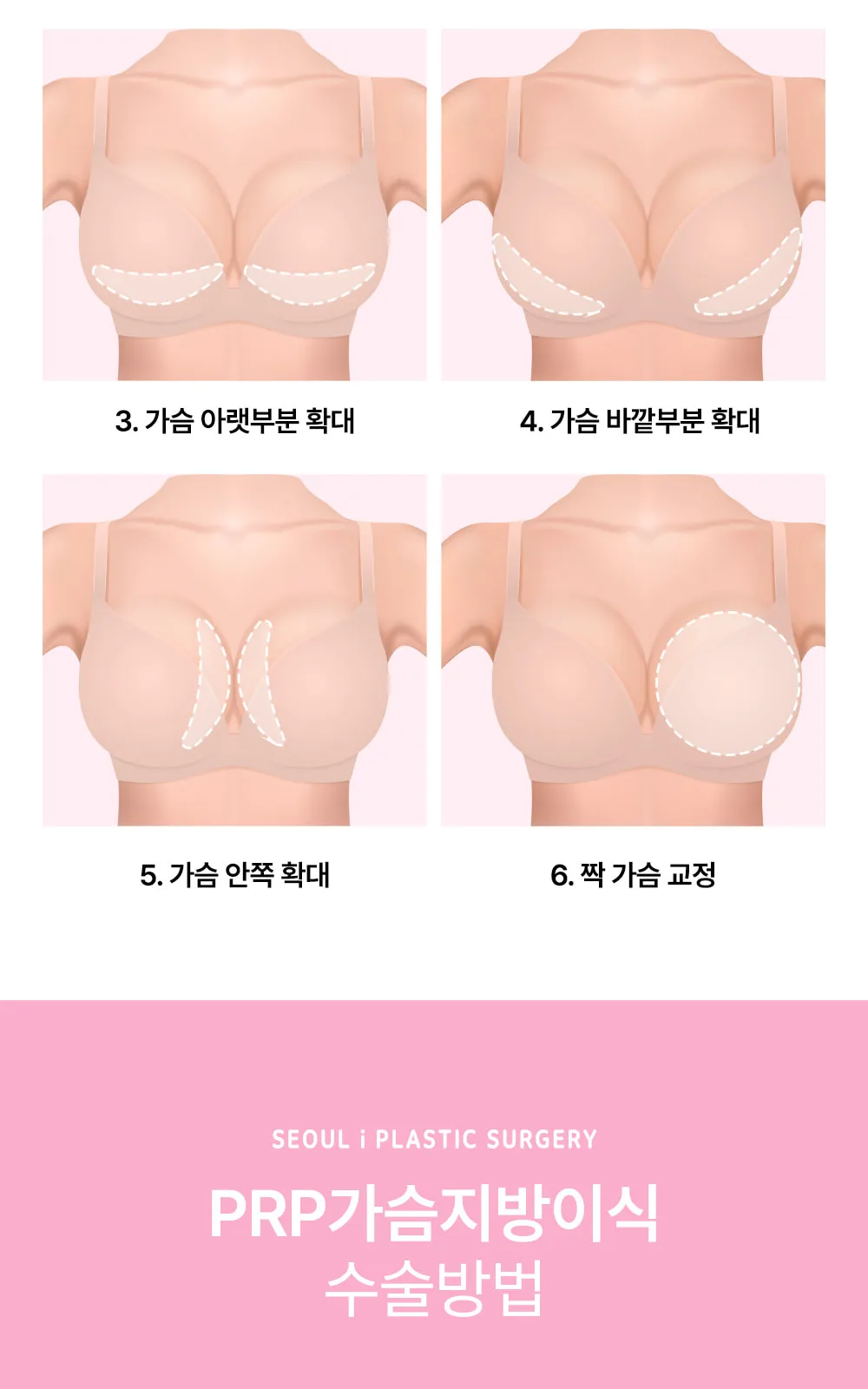 시술 상세 6
