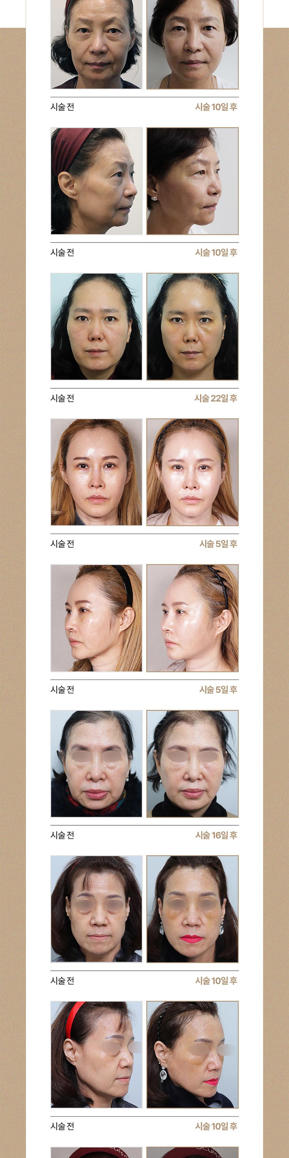 시술 상세 5