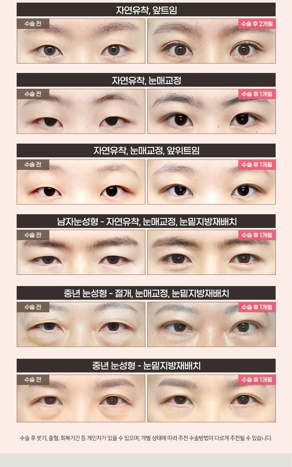 시술 상세 3
