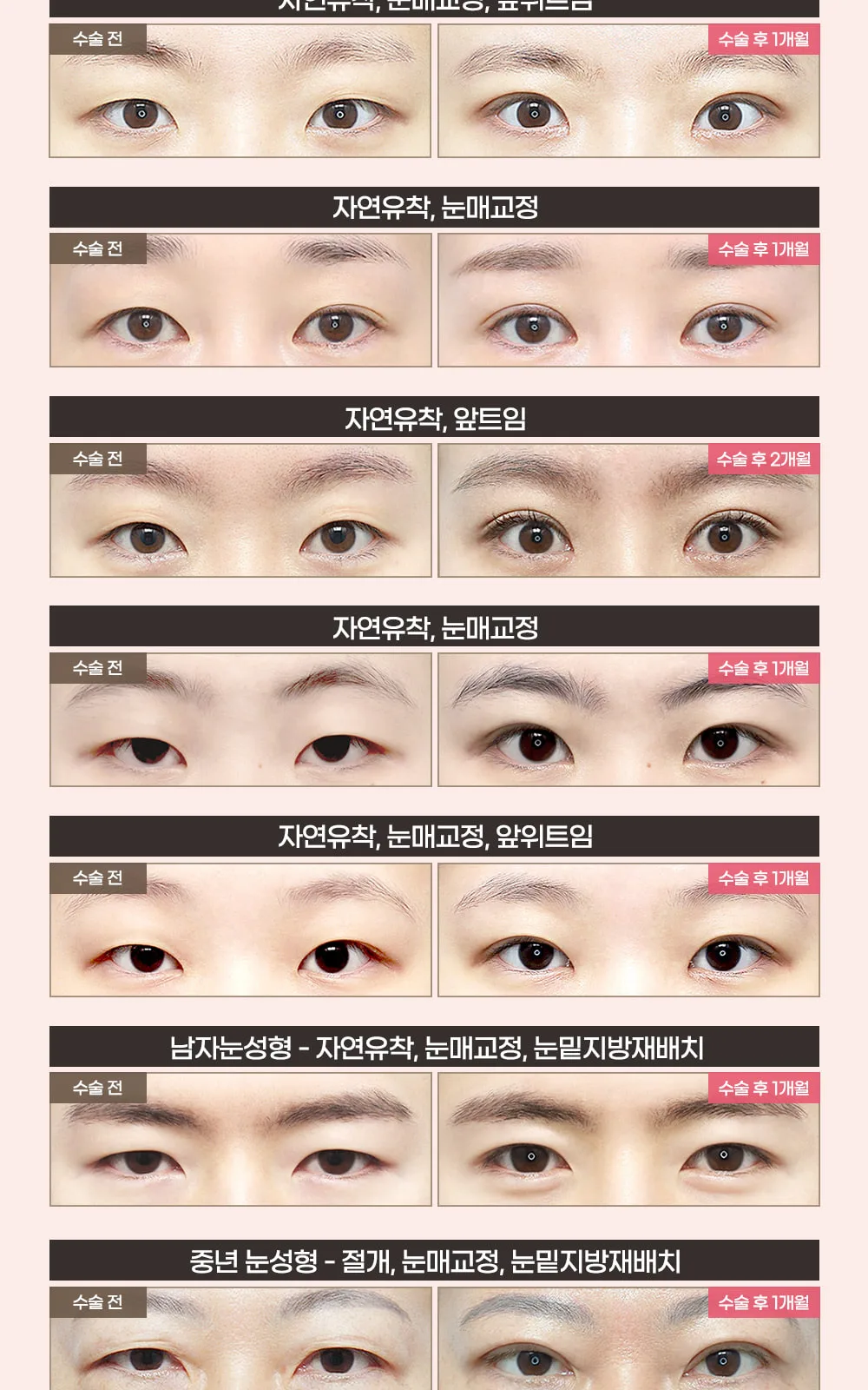 시술 상세 3