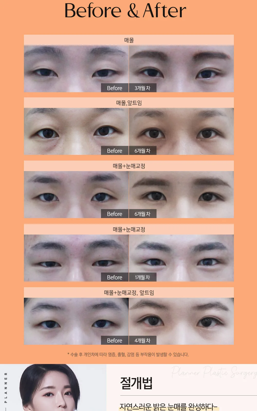 시술 상세 4